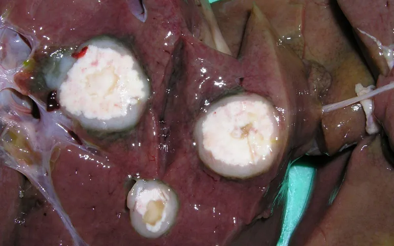 Coligranulomatosis: Hepatic Lymphoid Granulomas