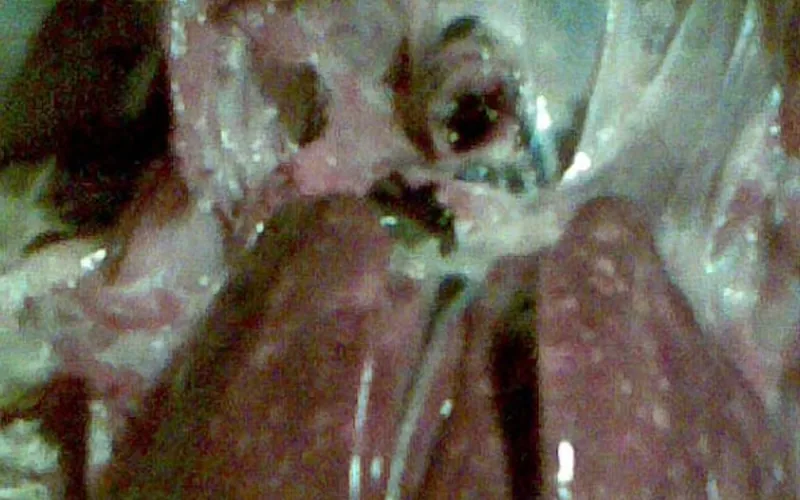 Fowl Cholera: Multifocal Necrosis