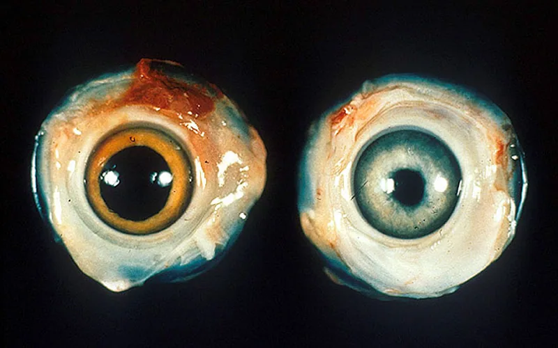 Adult chicken showing pathognomonic ocular Marek's disease (grey eye) with iris depigmentation and irregular pinpoint pupil